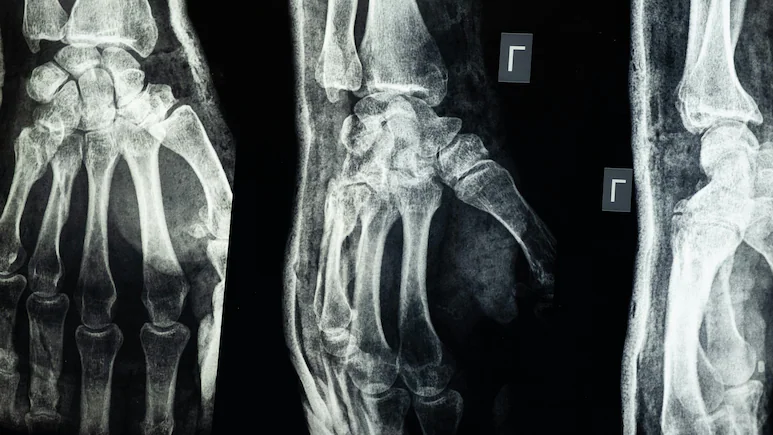 Bone Glue